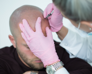 Another view of a technician carrying out Micro Scalp Pigmentation (MSP) on a male patient, showcasing the professional application process and the high-quality results of the treatment.