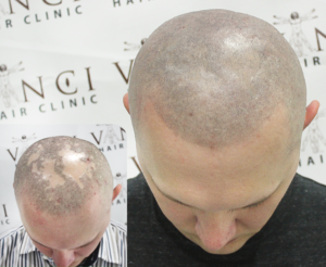 A man after going through MSP - The new treatment for alopecia.