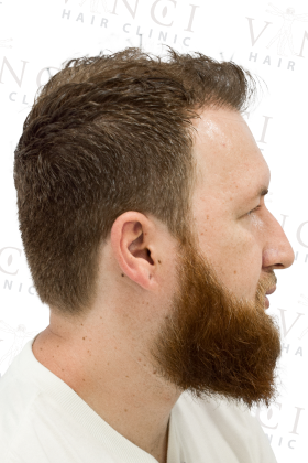 Bruno after 2800 graft FUE hair transplant at Vinci Hair Clinic