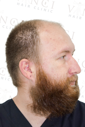 Bruno before 2800 graft FUE hair transplant at Vinci Hair Clinic