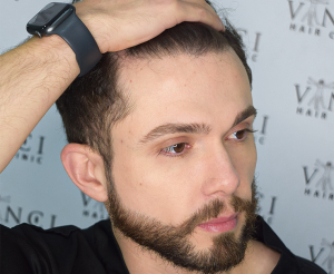 A man showing off his amazing hairline after a hair transplant with Vinci Hair Clinic answering the question, Are Hair Transplants Permanent