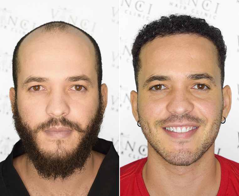 Its Not About the Money…Why a Good Hair Transplant Isnt All About Cost.