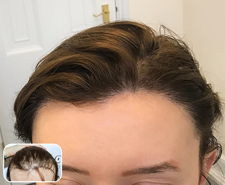Are my temples thinning  rHaircareScience