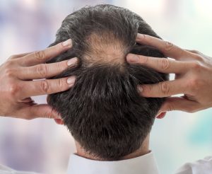 A photo of a man worried about his hair loss with a bald spot growing on his crown which has beens sped up by stress hair loss
