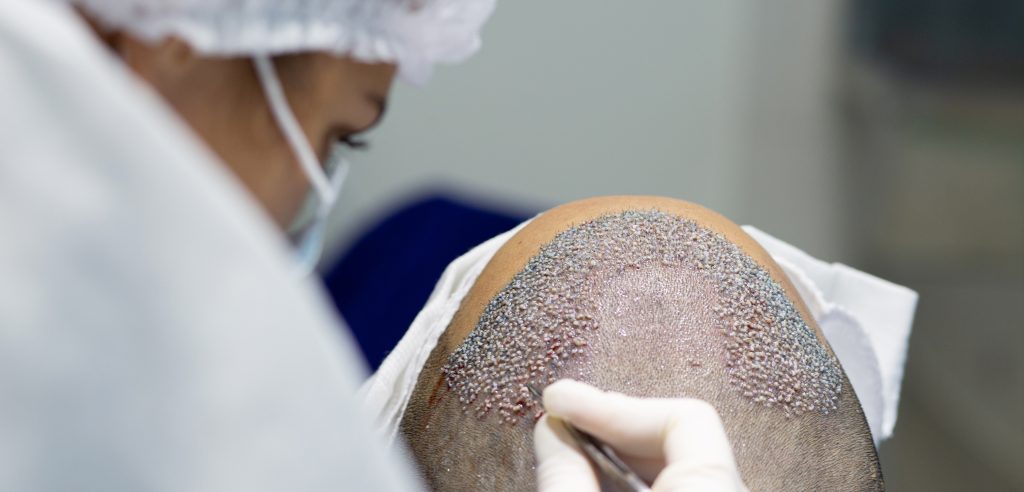 A photo of a man undergoing a hair transplant after contemplating which is best FUT vs FUE hair transplant vs DHI Hair Transplant and deciding on FUE