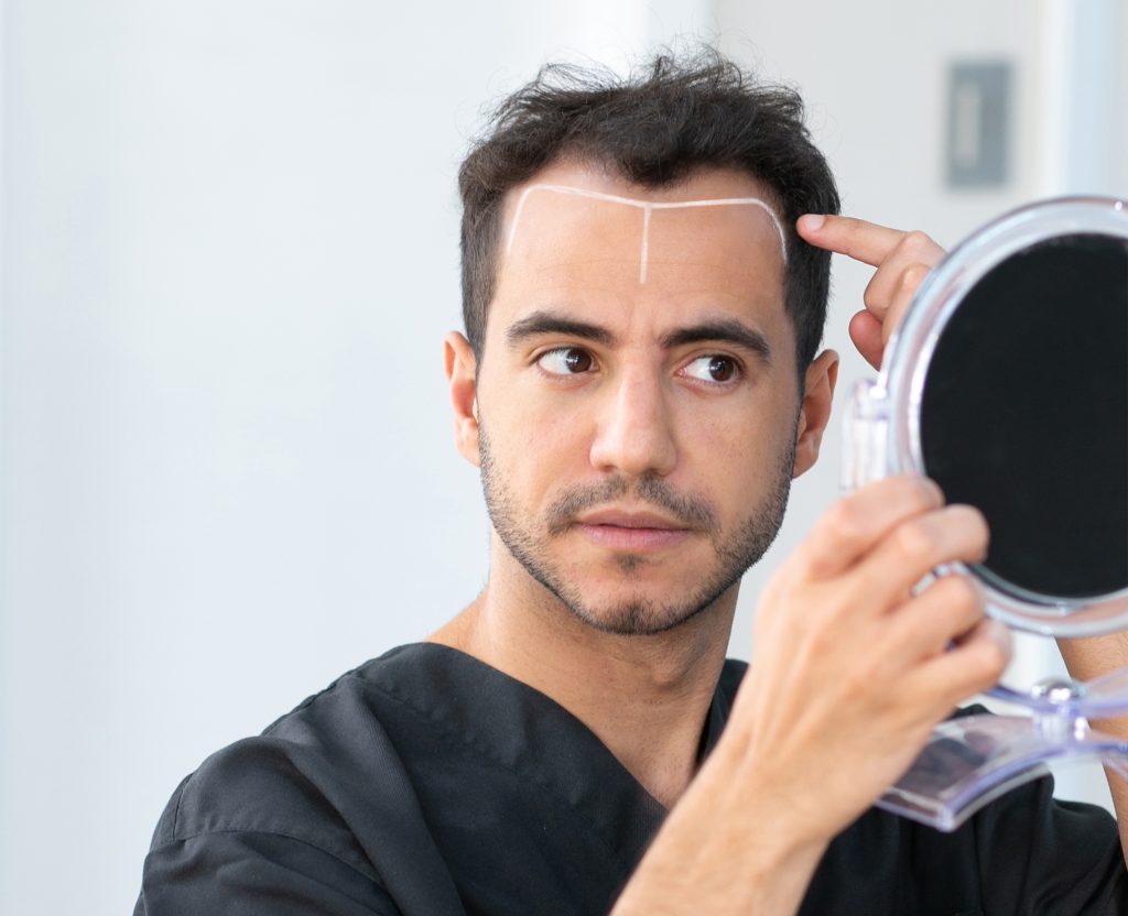 Vinci Hair Clinic consultation: a patient reviewing his hairline with a clinician before treatment