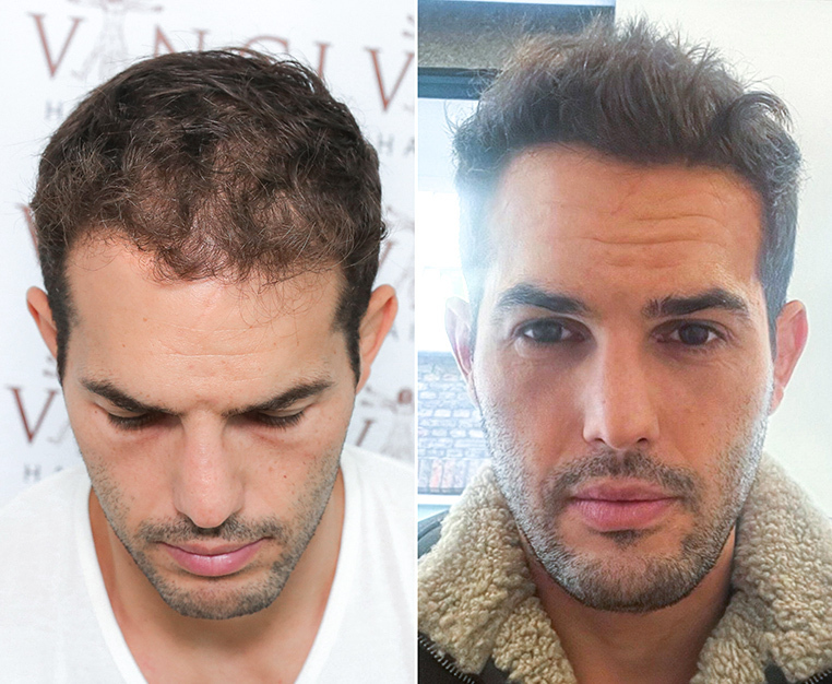 Photo of before and after treatment at Vinci Hair Clinic. Did he have PRP or Mesotherapy. He had both.