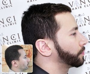 A before and after picture of a man, the before photo has his side profile with a sparse, thin beard. The after is him with a thick fuller beard.