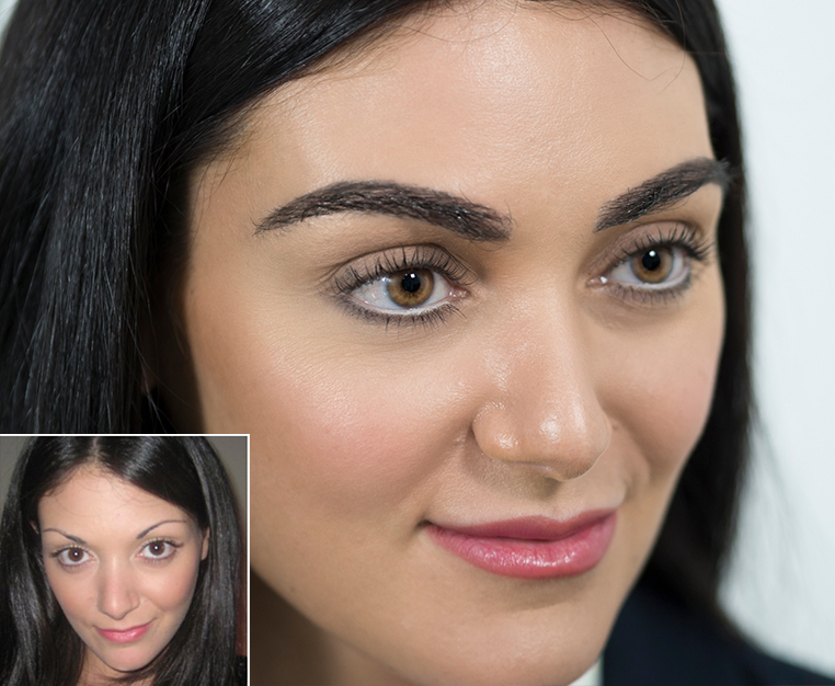 How an Eyebrow Transplant Can make Your Face Look Younger 1