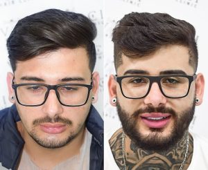 A before and after of a man firstly with a glum expression and a thin beard, then an after photo looking much happier with a full thick beard he achived with a beard transplant at Vinci Hair Clinic