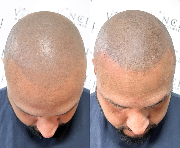 Before After Micro Scalp Pigmentation MSP Uncovered Pros and Cons