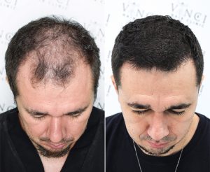 A before and after treatment of a man who underwent new hair treatment for hair loss at vinci hair clinic and ended up with a thick full head of hair and a strong hairline.