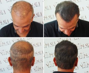 A man who experienced severe over-harvesting as a result of poor treatment by another hair transplant clinic. Then an after photo showing the much improved look with completely hidden scarring making it invisible after MSP treatment