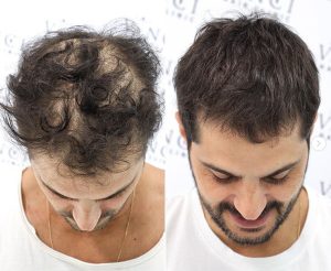 A mans before and after picture showing a dramatic result of his hair Improvement despite the surprisingly low hair transplant costs UK