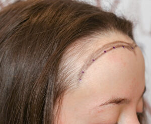 A women about to have a hair transplants for women, with the new hair line sketched out.