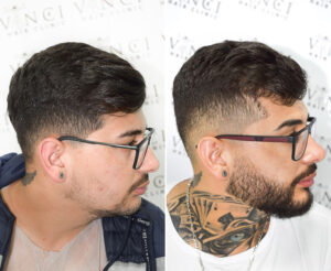 A before and after photo of a man who received a beard transplant. So how long do beard transplants last. Short answer, forever.