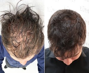 A before and after photo showing the hair transplant timeline from thin hair to thick and full hair