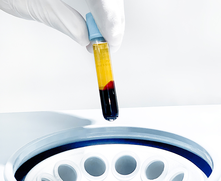 Platelet Rich Plasma PRP Therapy A Promising Approach to Androgenetic Alopecia 2