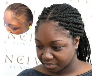 Afro Hair Transplant on a female client done at Vinci Hair Clinic.