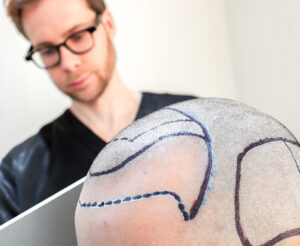 A man preparing for Vinci Hair Transplant Hair Transplant with the different transplant areas marked out, being informed of the hair transplant aftercare and recovery steps