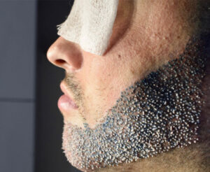 What is a Beard Transplant?