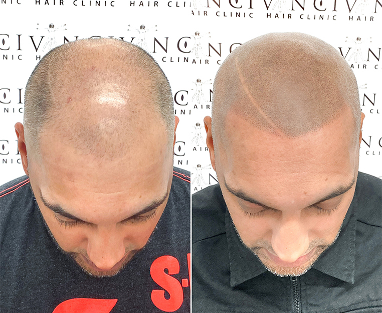 From MSP to Low level Laser Therapy LLLT Treat Hair Loss With These Non Invasive Solutions