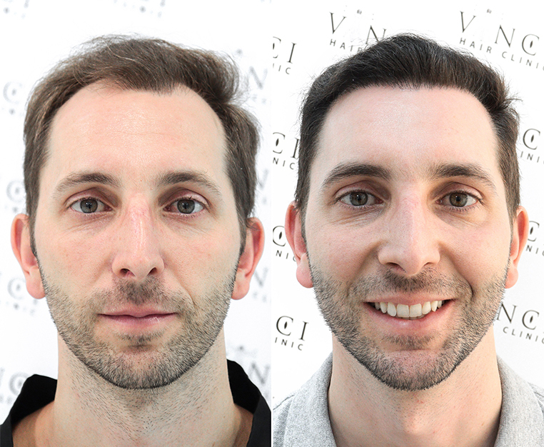 Natural Looking Results These Hair Transplants Look Barely Indistinguishable