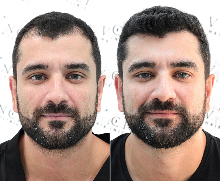 What is The Best Age For A Hair Transplant