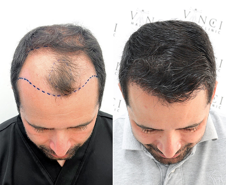 From Hair Transplants to Regrowth Injections 5 Reasons Why This is The Premier Destination for Hair Restoration