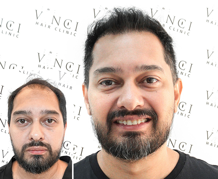 Achieve Confidence With This Celebrity Grade Hair Transplant 2