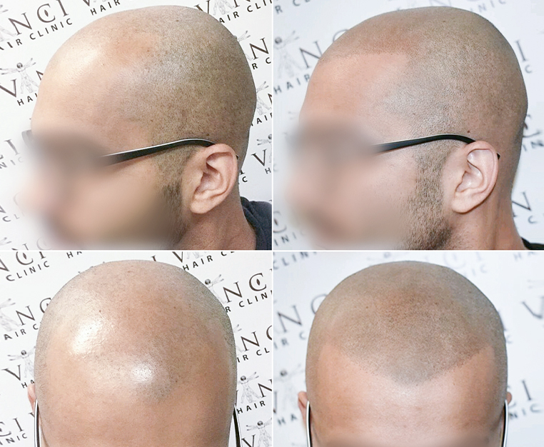 Is Micro Scalp Pigmentation MSP Painful Myths and Facts