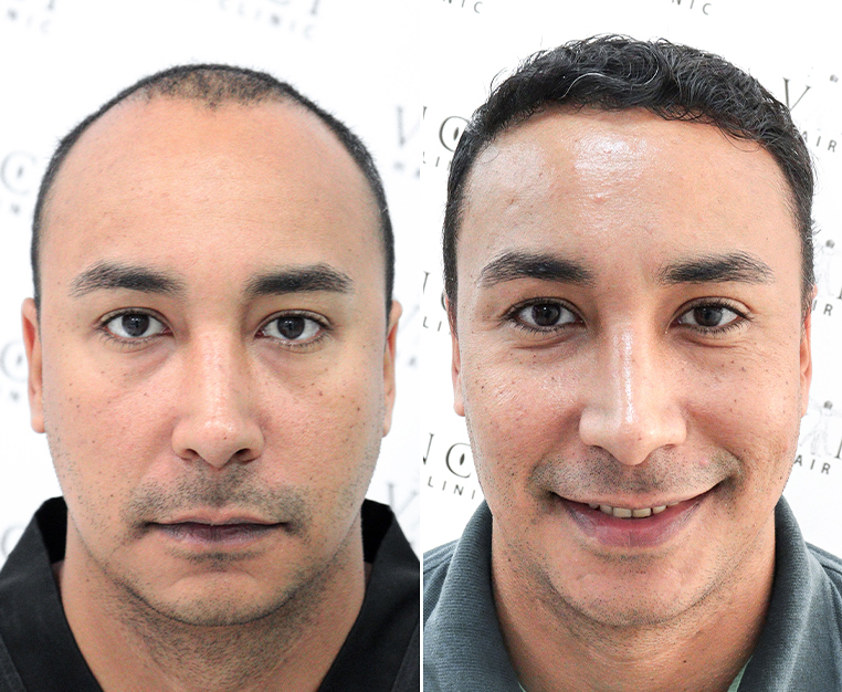 Thinking About a Hair Transplant Heres What You Need to Know