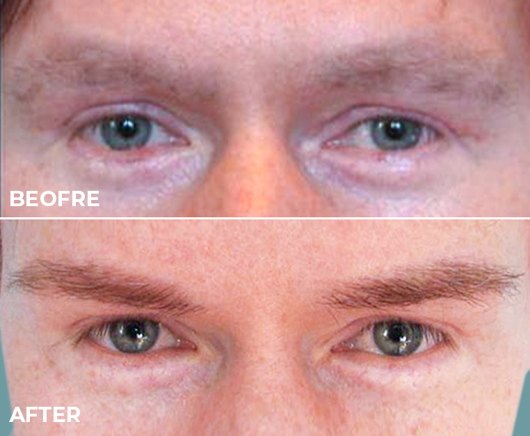 Eyebrow Transplants Explained_ How to Regrow Your Brows with Your Own Hair