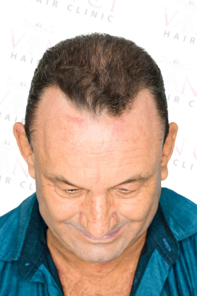 Janio after a 3,300 graft FUE hair transplant at Vinci Hair Clinic