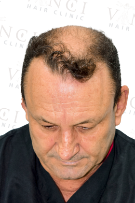 Janio before a 3,300 graft FUE hair transplant at Vinci Hair Clinic
