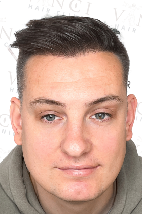 George after 1500 graft FUE hair transplant at Vinci Hair Clinic