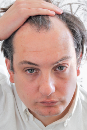 George before 1500 graft FUE hair transplant at Vinci Hair Clinic