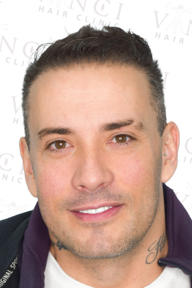 Joao after 3700 graft FUE hair transplant at Vinci Hair Clinic