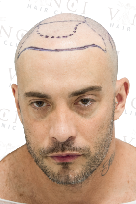 Joao before 3700 graft FUE hair transplant at Vinci Hair Clinic