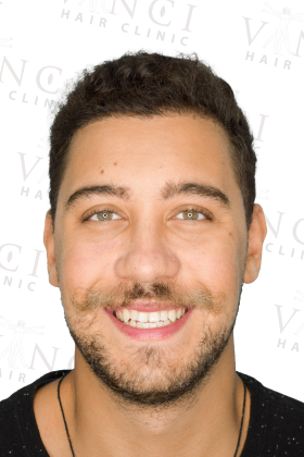 Rodrigo after 2000 graft FUE hair transplant at Vinci Hair Clinic